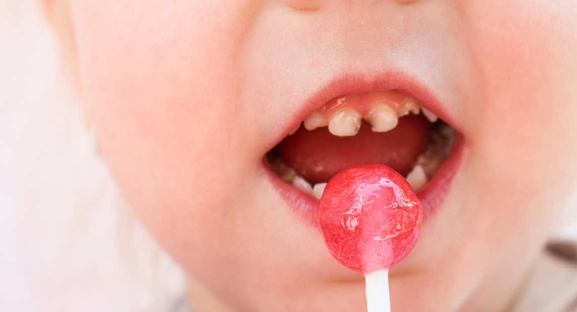 Mi a teendő, ha gyermekednek súlyos fogszuvasodása van?